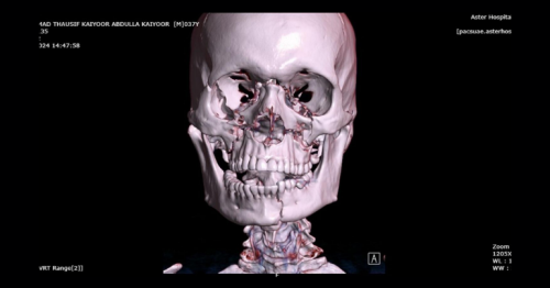  Accident ‘crushes every facial bone’ of delivery